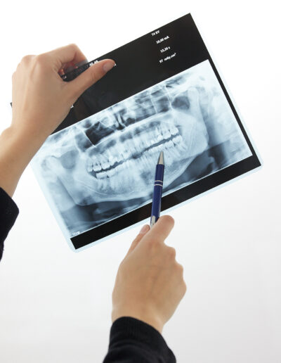Chirurgia stomatologiczna w Stomatologii Bamberski Dwór w Poznaniu na Jeżycach, usuwanie ósemek.