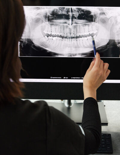 Zdjęcie RTG zatrzymanej ósemki, ząb mądrości do usunięcia.