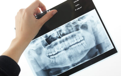 Zdjęcie panoramiczne zębów RTG w Poznaniu – Radiowizjografia