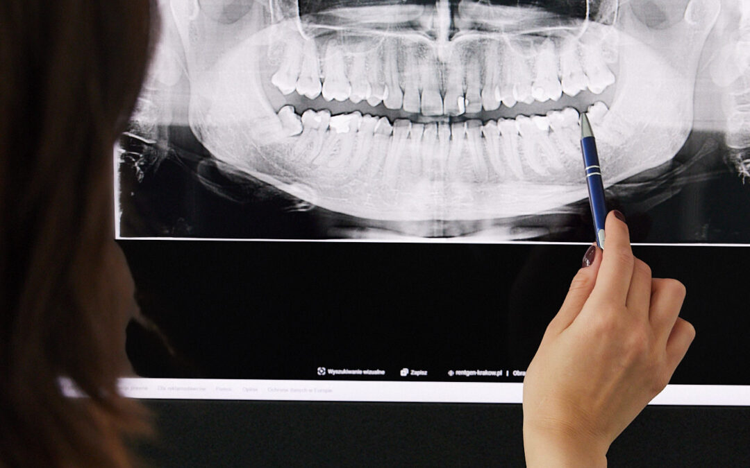 zdjęcie panoramiczne RTG, zatrzymana ósemka ząb mądrości do usunięcia