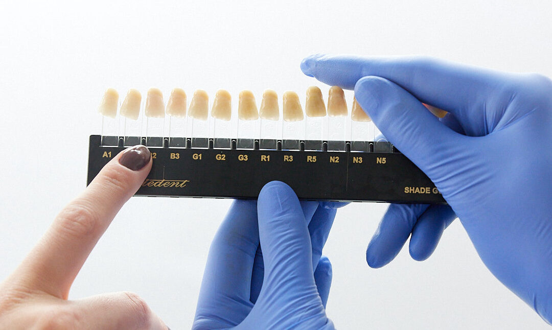 Nowoczesna protetyka stomatologiczna w Poznaniu, indywidualne uzupełnienia protetyczne dopasowane do potrzeb pacjenta i koloru zębów.