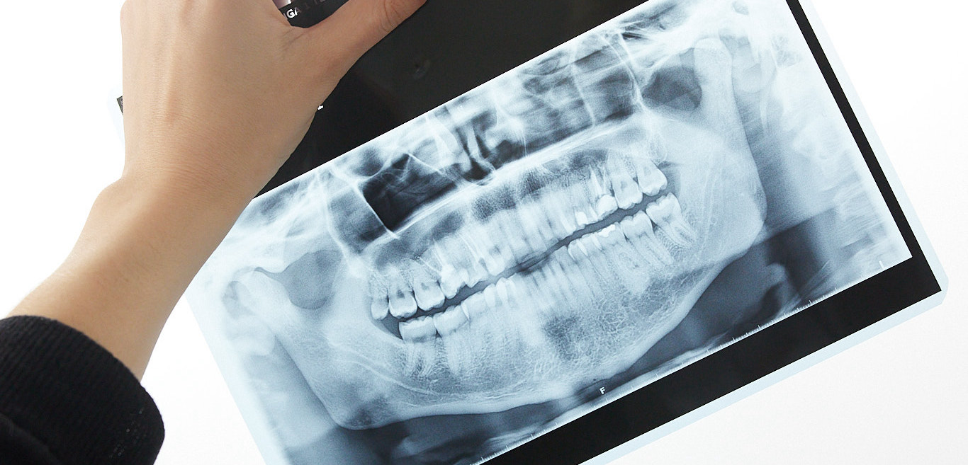 zdjecie panoramiczna potrzebne do dobrej diagnostyki zębów i leczenia jamy ustnej u dentysty