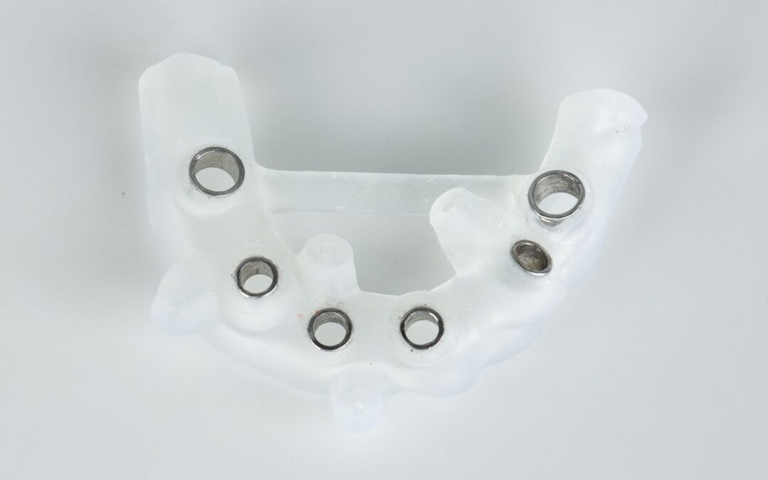 Szablon implantologiczny – po co się go stosuje?