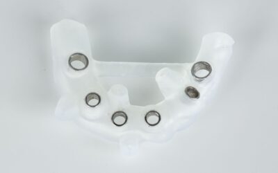 Szablon implantologiczny – po co się go stosuje?